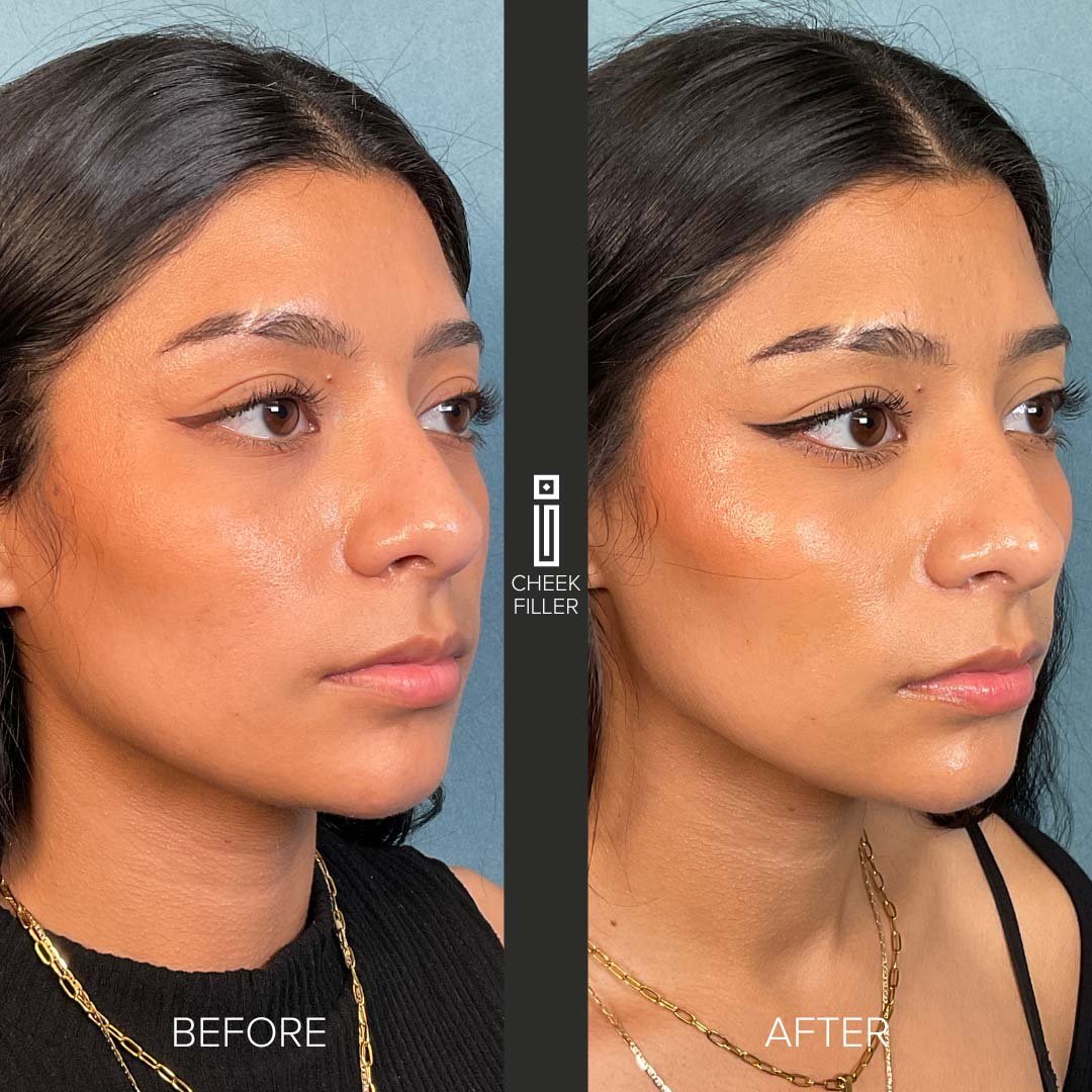 Patient results before and after dermal fillers at Impressions Chicago