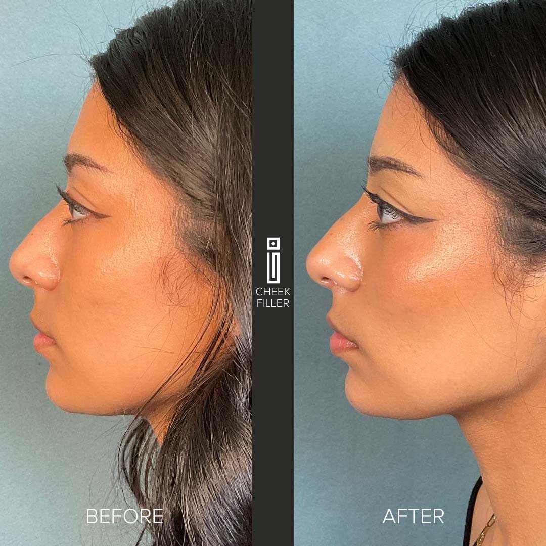 Dermal filler before and after photo showing natural facial rejuvenation