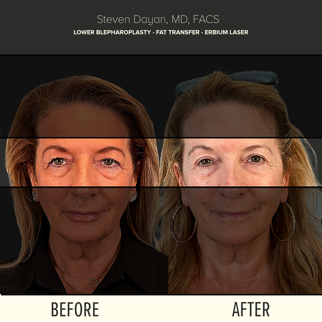 BEFORE + AFTERS-64