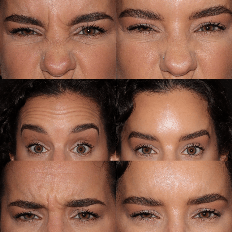 Botox in Chicago | Over 20,000 Injections Performed
