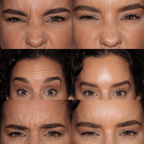 BOTOX-by-Dr.-Ladha BOTOX-by-Dr.-Ladha