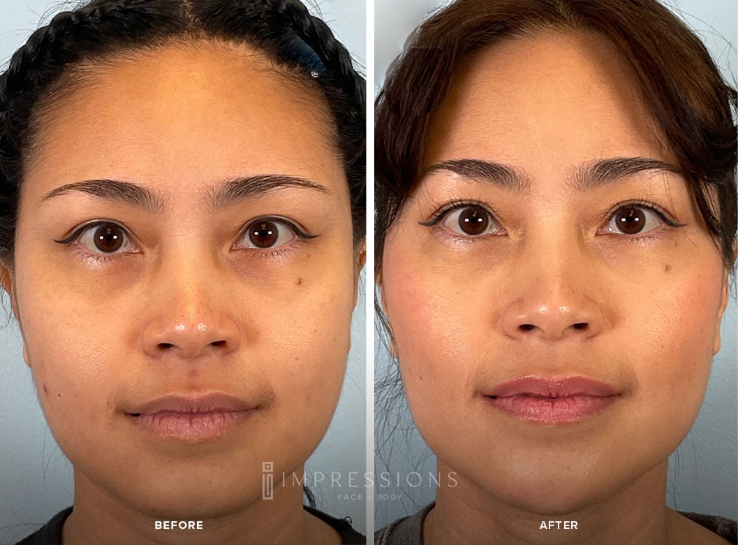 Buccal_Fat_Case_2_Shot_1