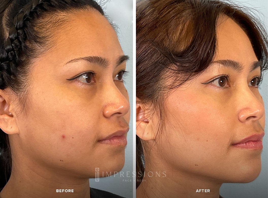 Buccal_Fat_Case_2_Shot_2