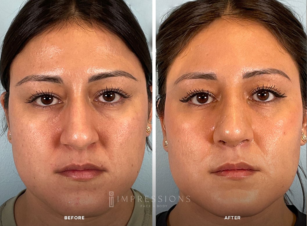 Buccal_Fat_Case_3_Shot_1_