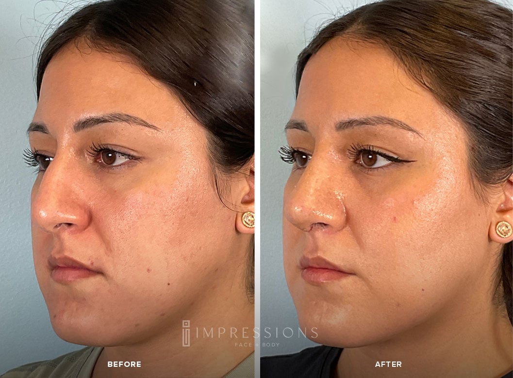 Buccal_Fat_Case_3_Shot_2_