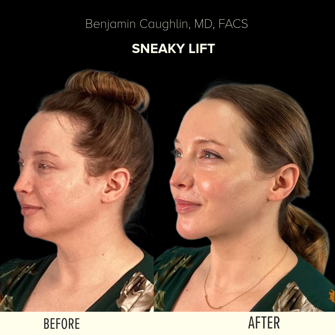 Before & After The Sneaky Lift lower face procedure in Chicago - Impressions Face + Body