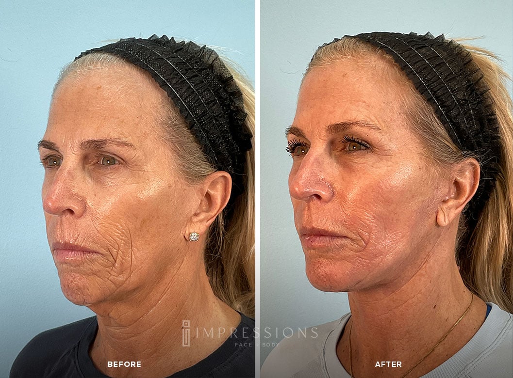 Chin_Case_1_shot#3