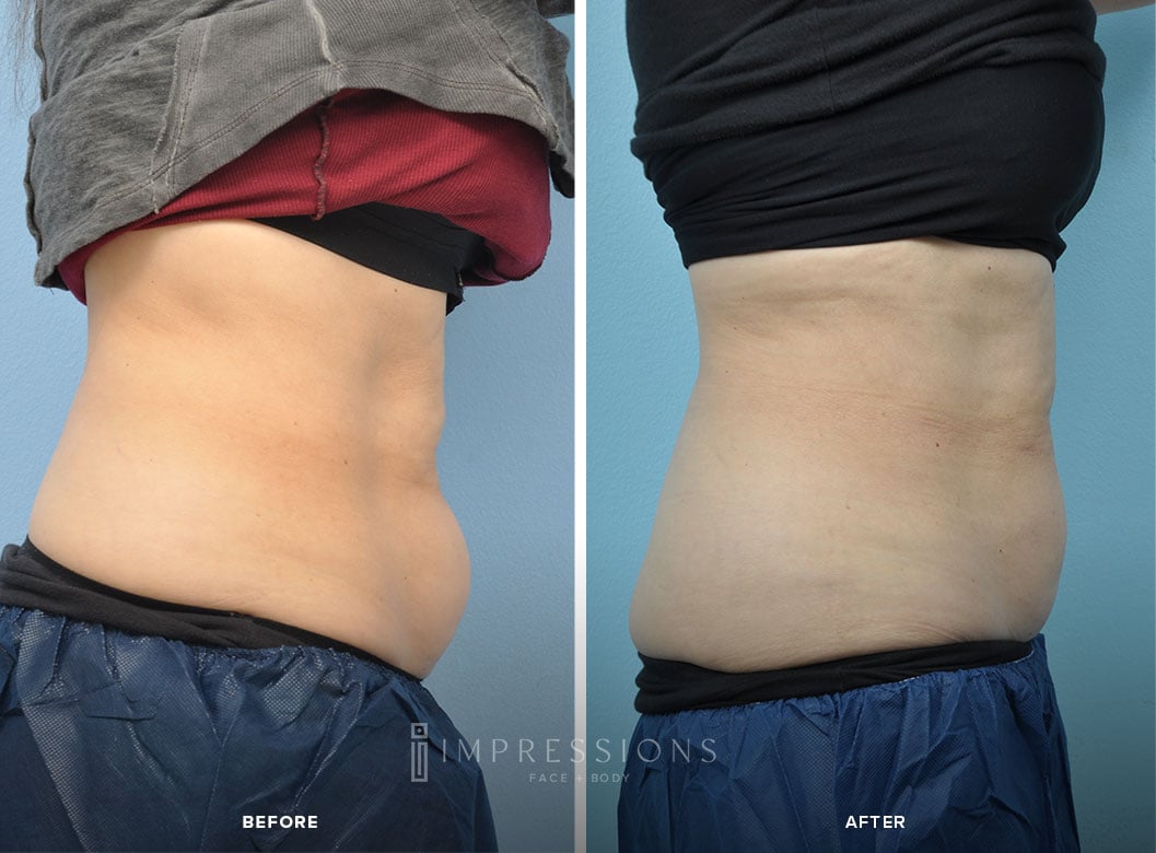 Cool_Sculpting_Case_2_shot#2