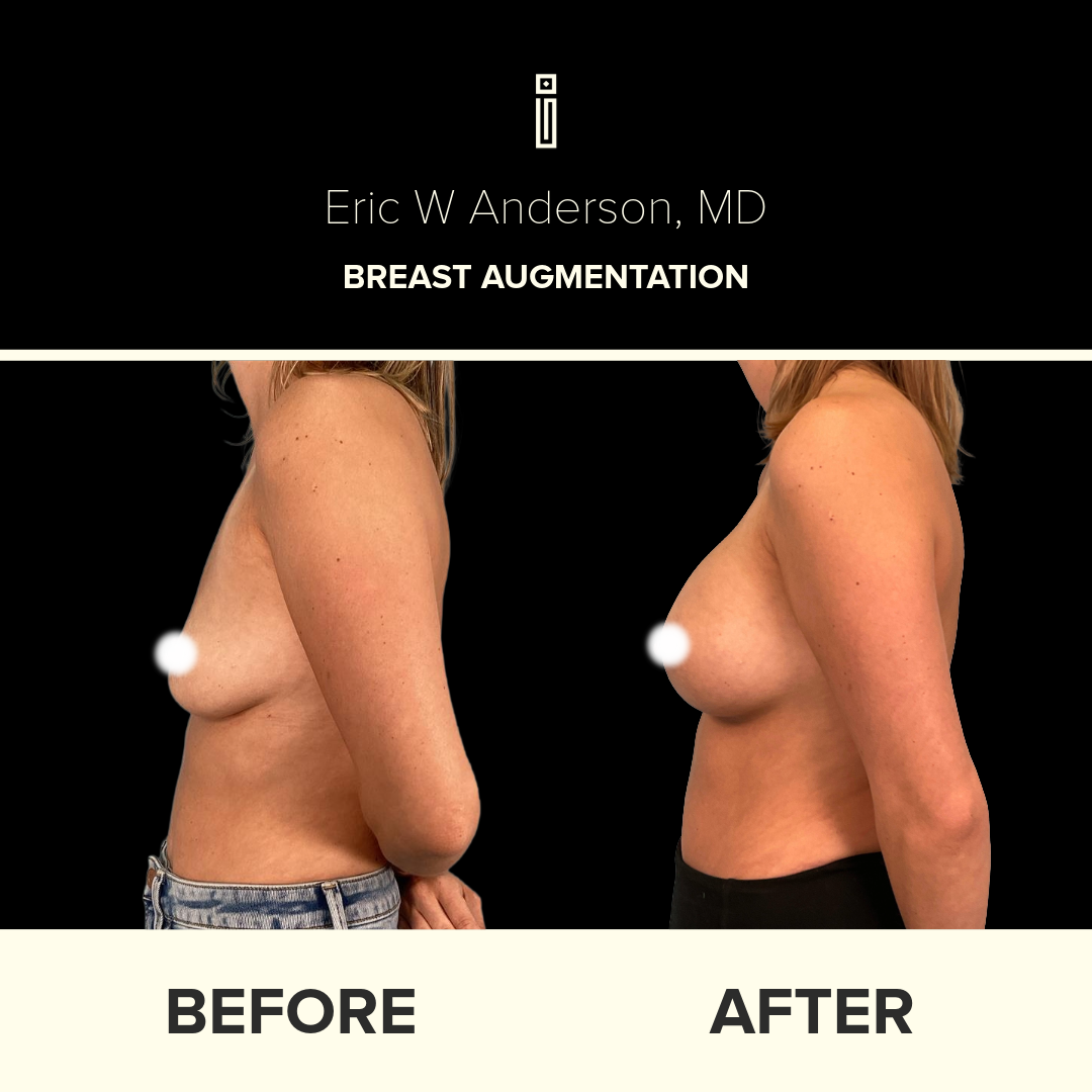 Dr. Anderson Breast B&A 33