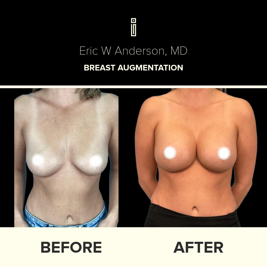 Dr. Anderson Breast B&A 35