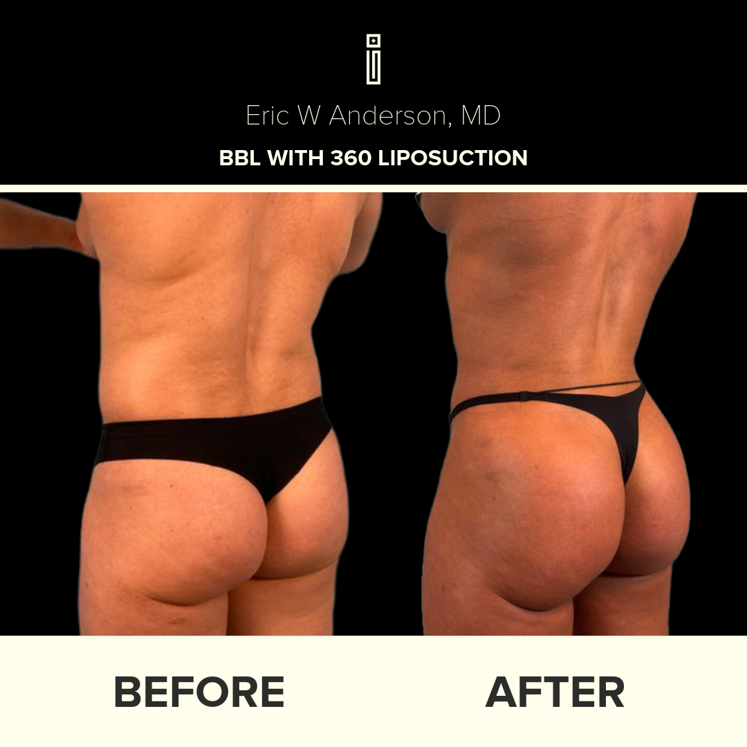 Dr. Anderson Liposuction B&A (12)