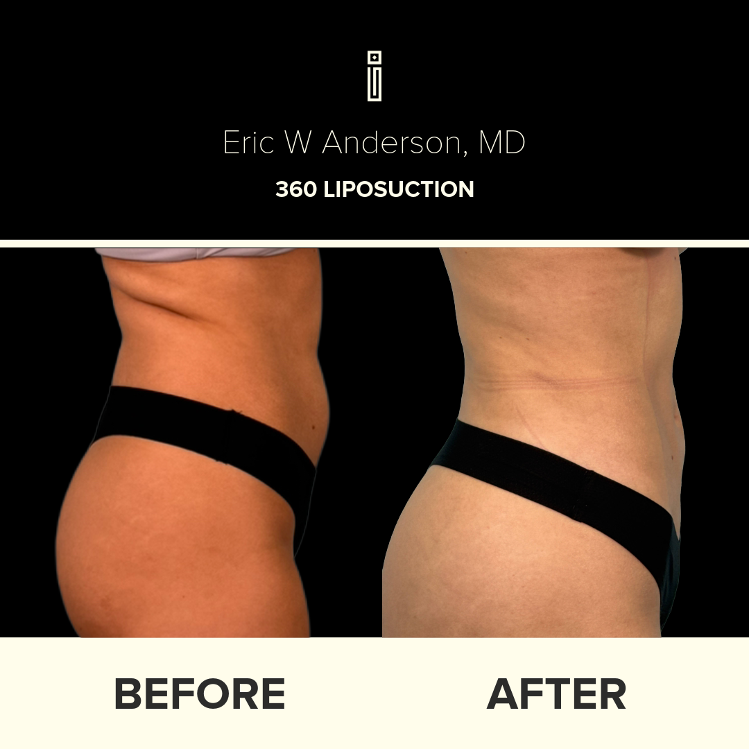 Dr. Anderson Liposuction B&A (24)