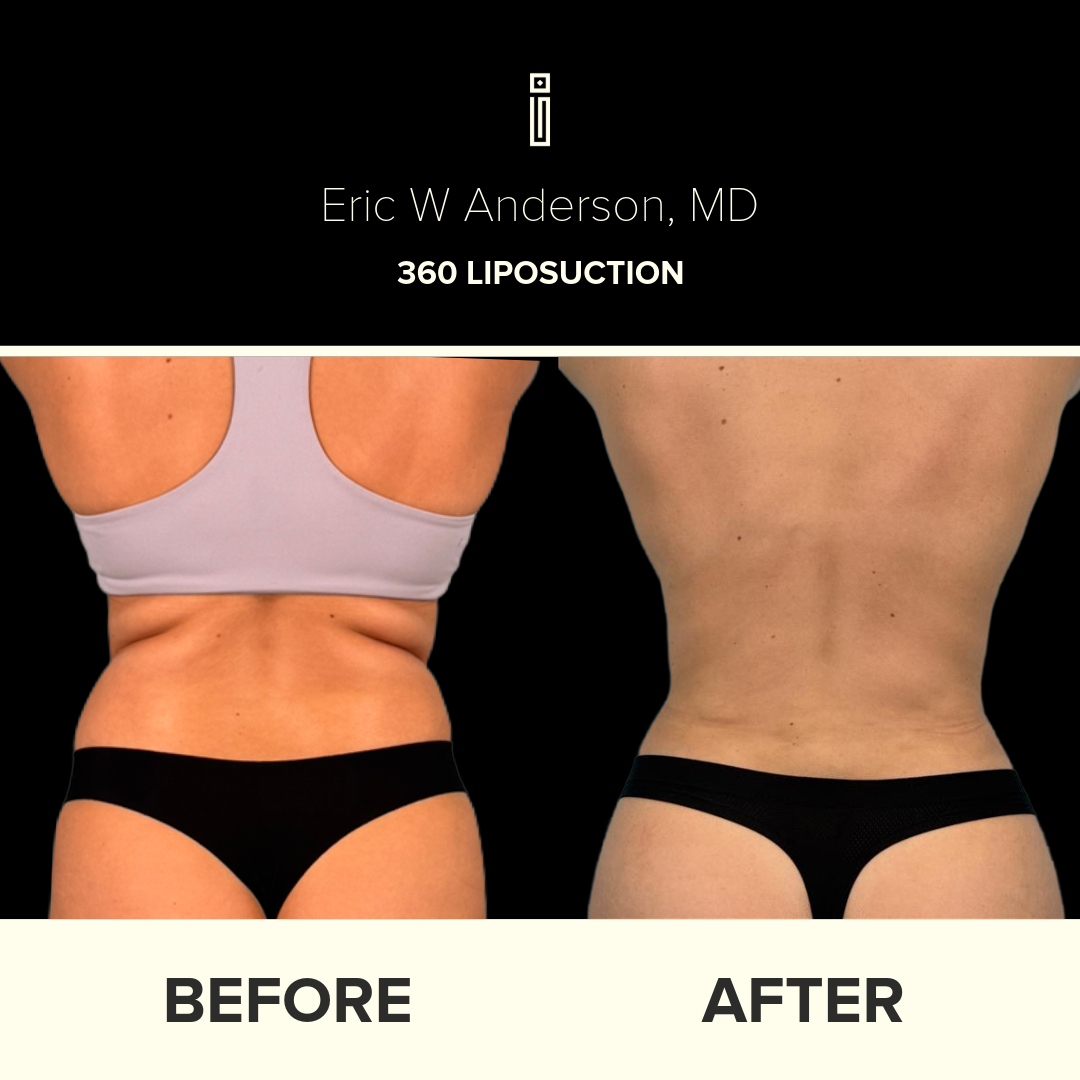 Dr. Anderson Liposuction B&A (25)