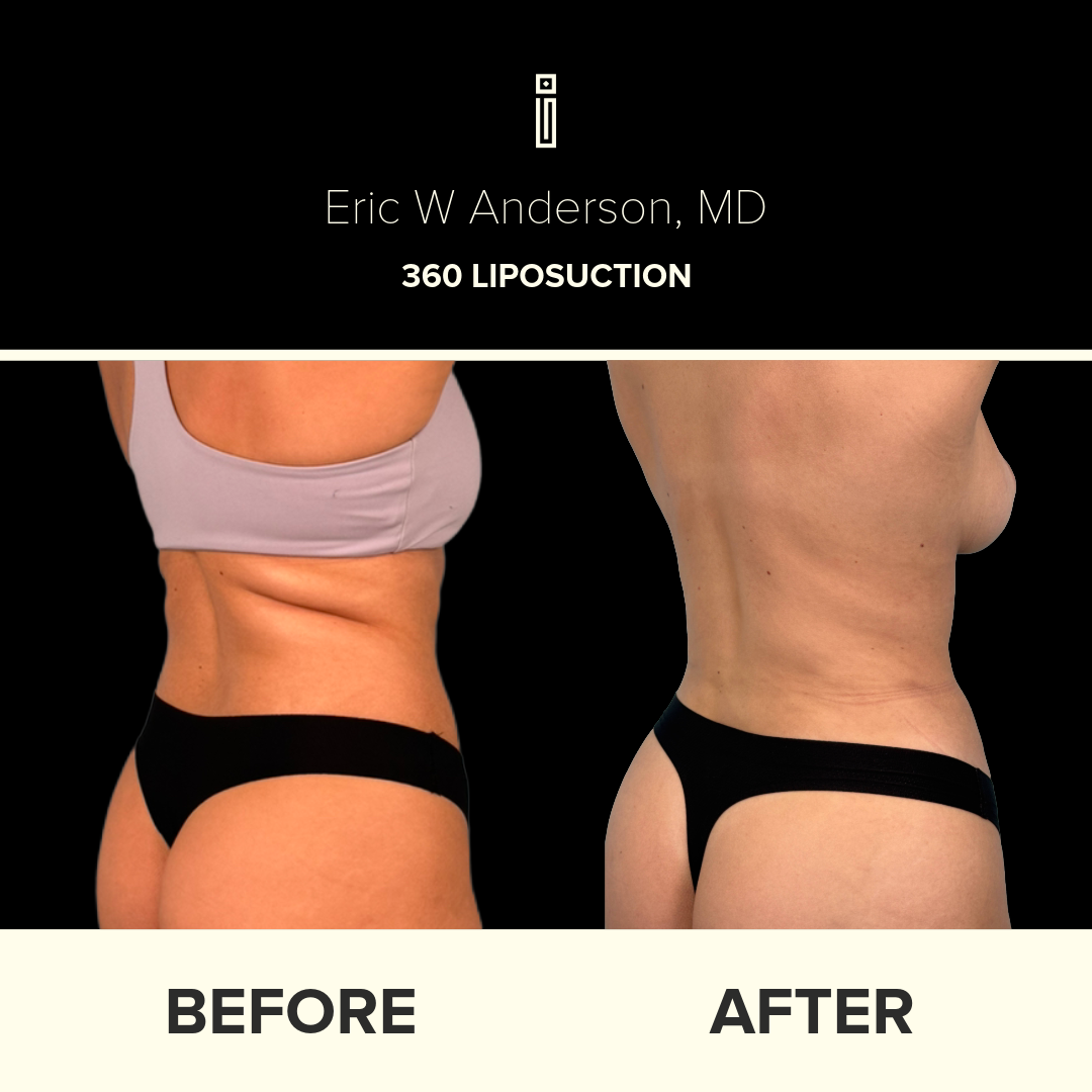 Dr. Anderson Liposuction B&A (26)