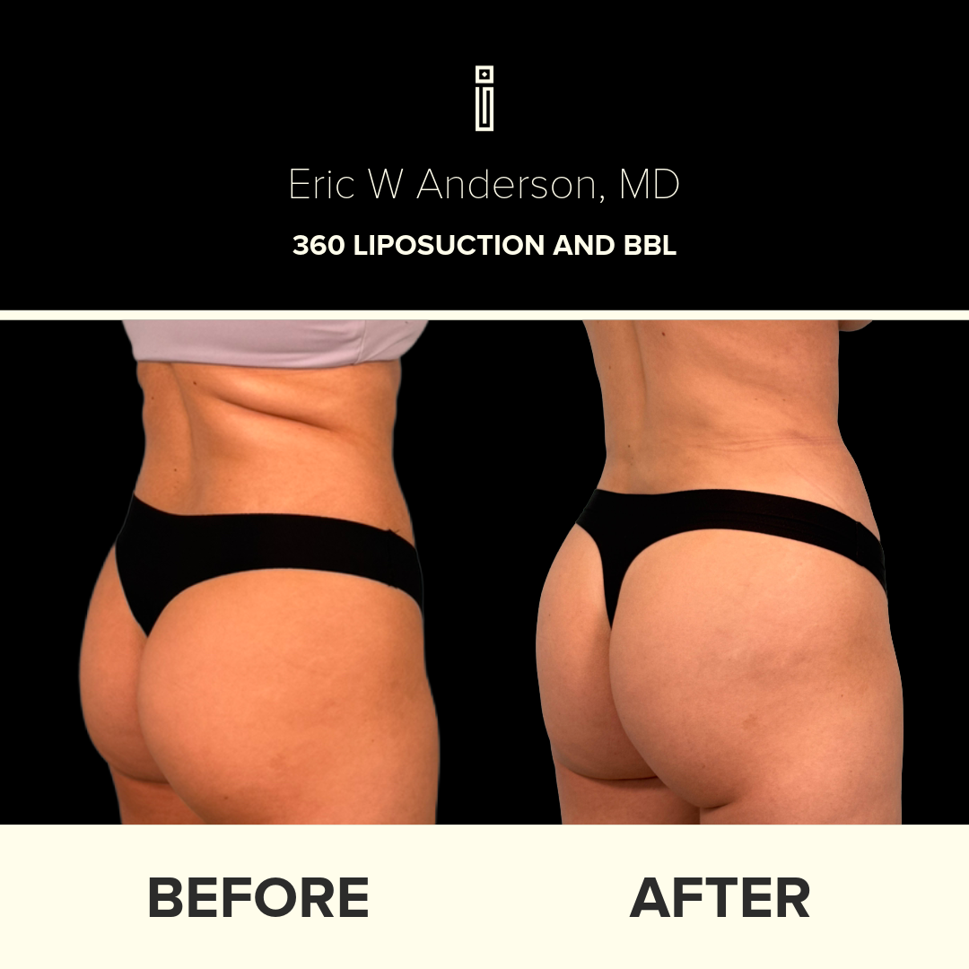 Dr. Anderson Liposuction B&A (27)