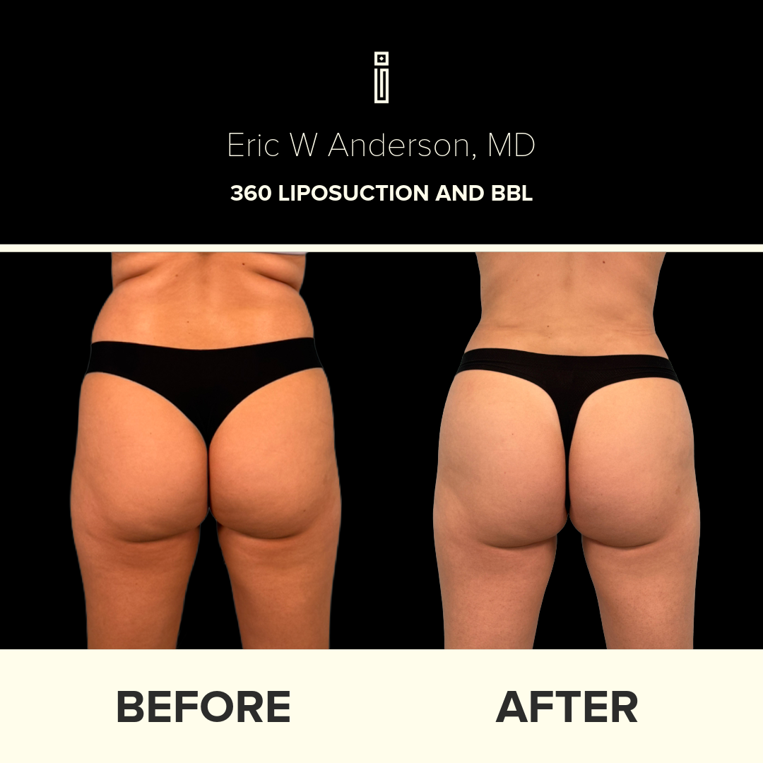 Dr. Anderson Liposuction B&A (28)
