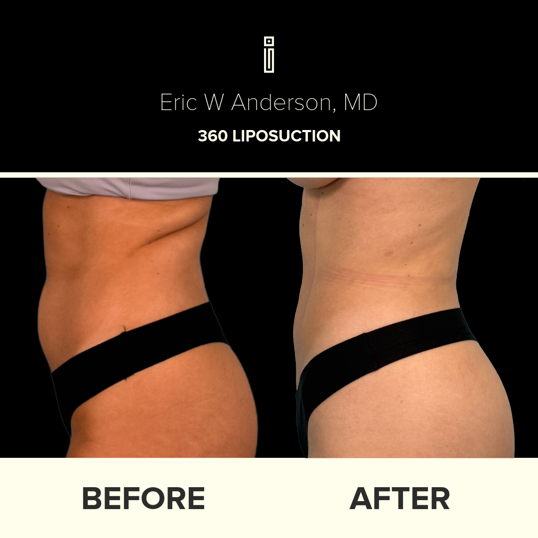 Dr. Anderson Liposuction B&A (29)