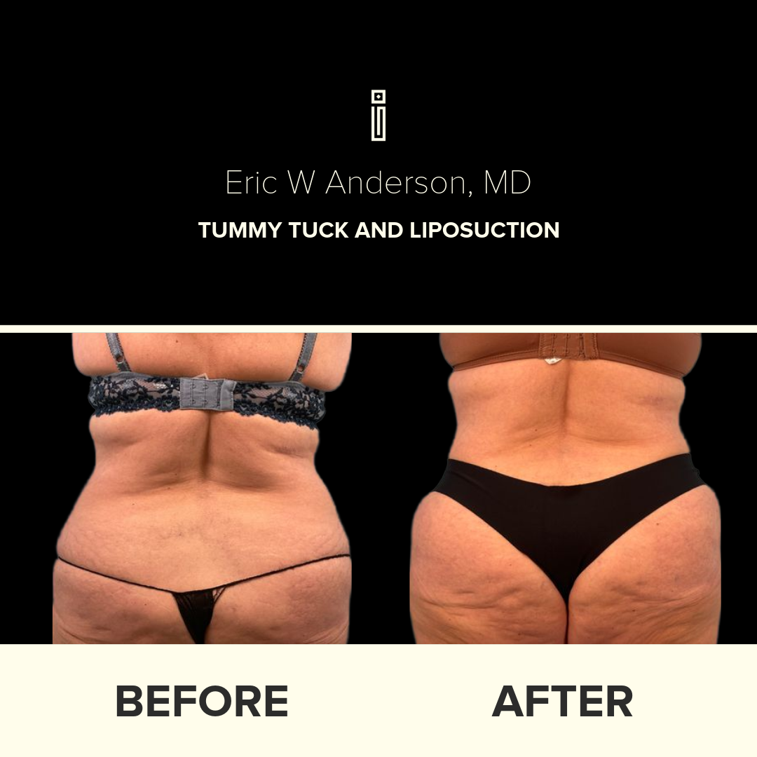 Dr. Anderson Liposuction B&A (4)