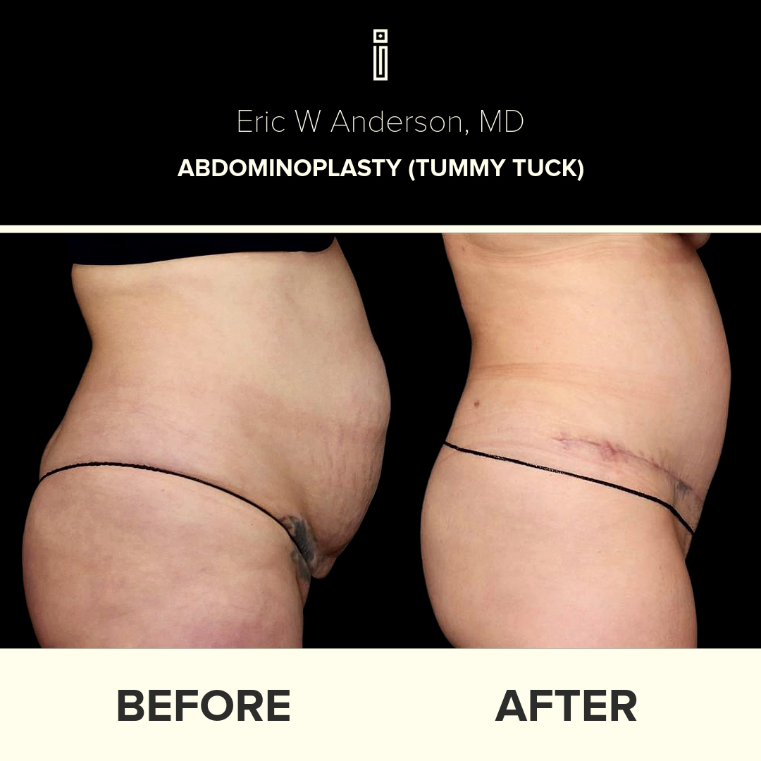 Dr. Anderson Liposuction B&A (8)