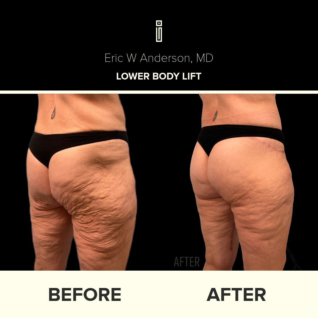 Dr. Anderson Liposuction B&A (9)