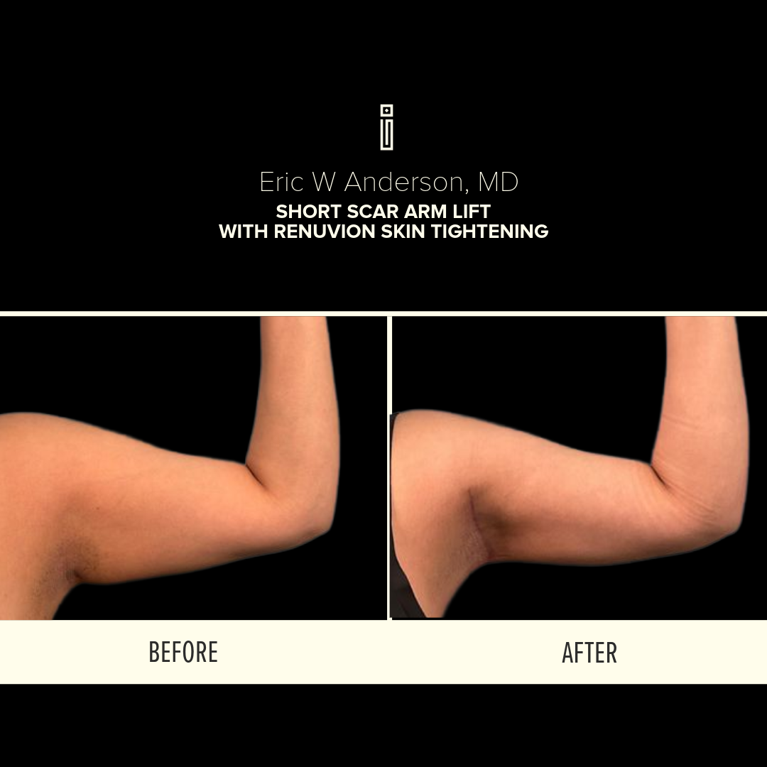 Dr.Anderson10.25-1-Clarke - Arm Lift Landing Page  1