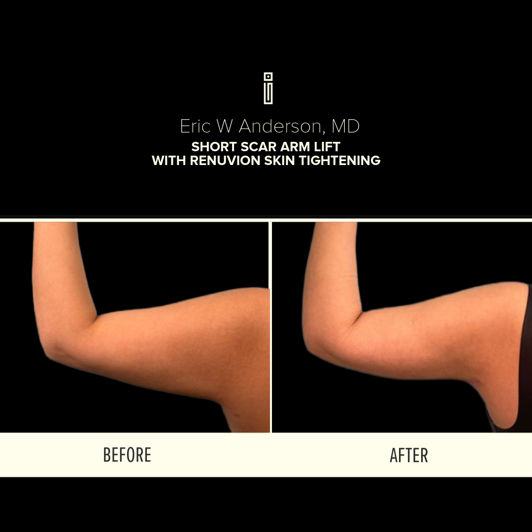 Dr.Anderson10.25-2-Clarke - Arm Lift Landing Page  1