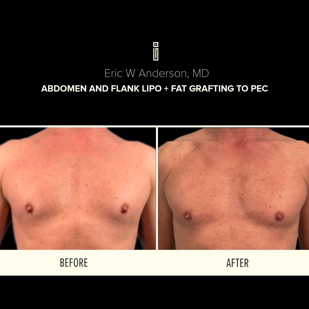Abdomen + Flank Lipo + fat grafting to pec