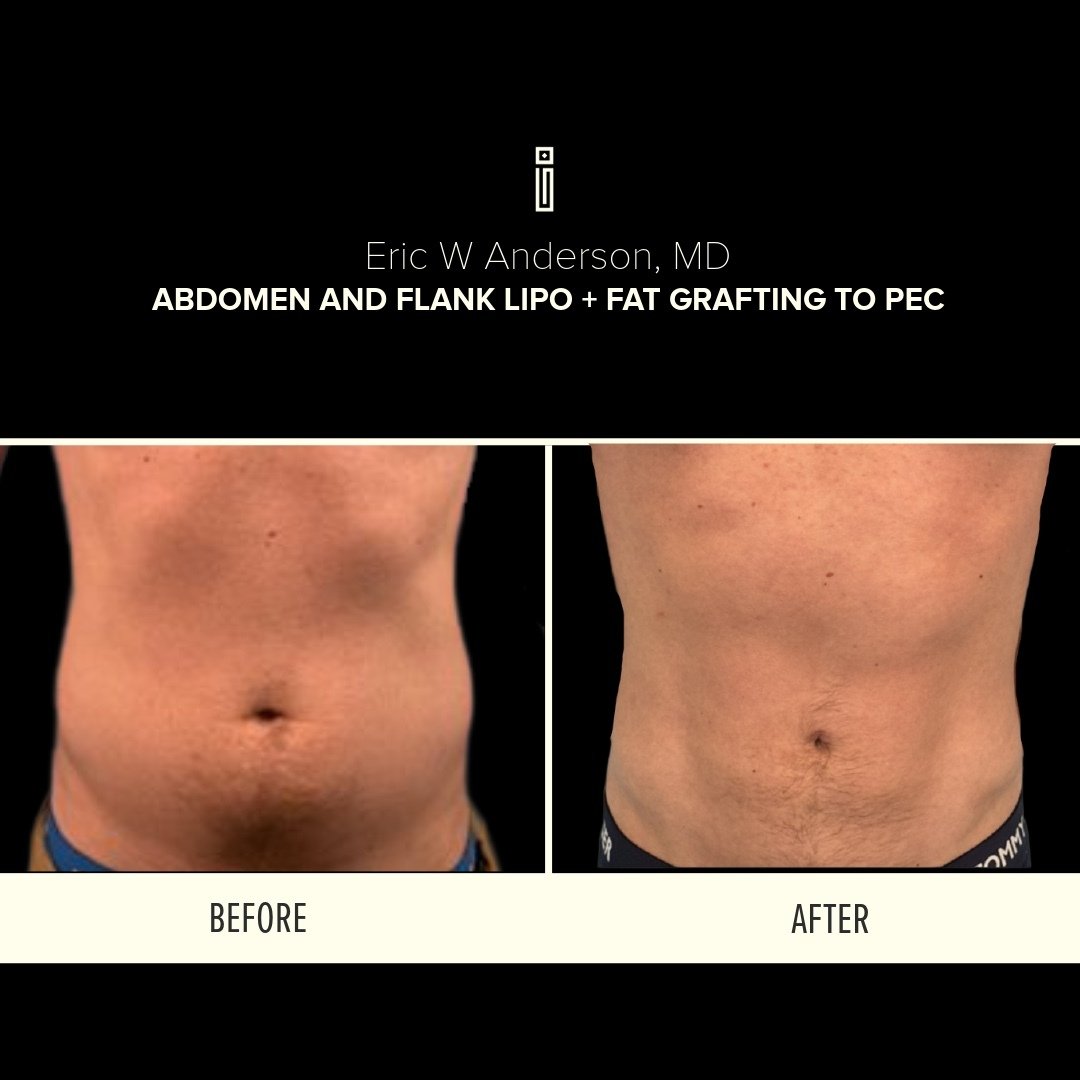 Abdomen + Flank Lipo + fat grafting to pec
