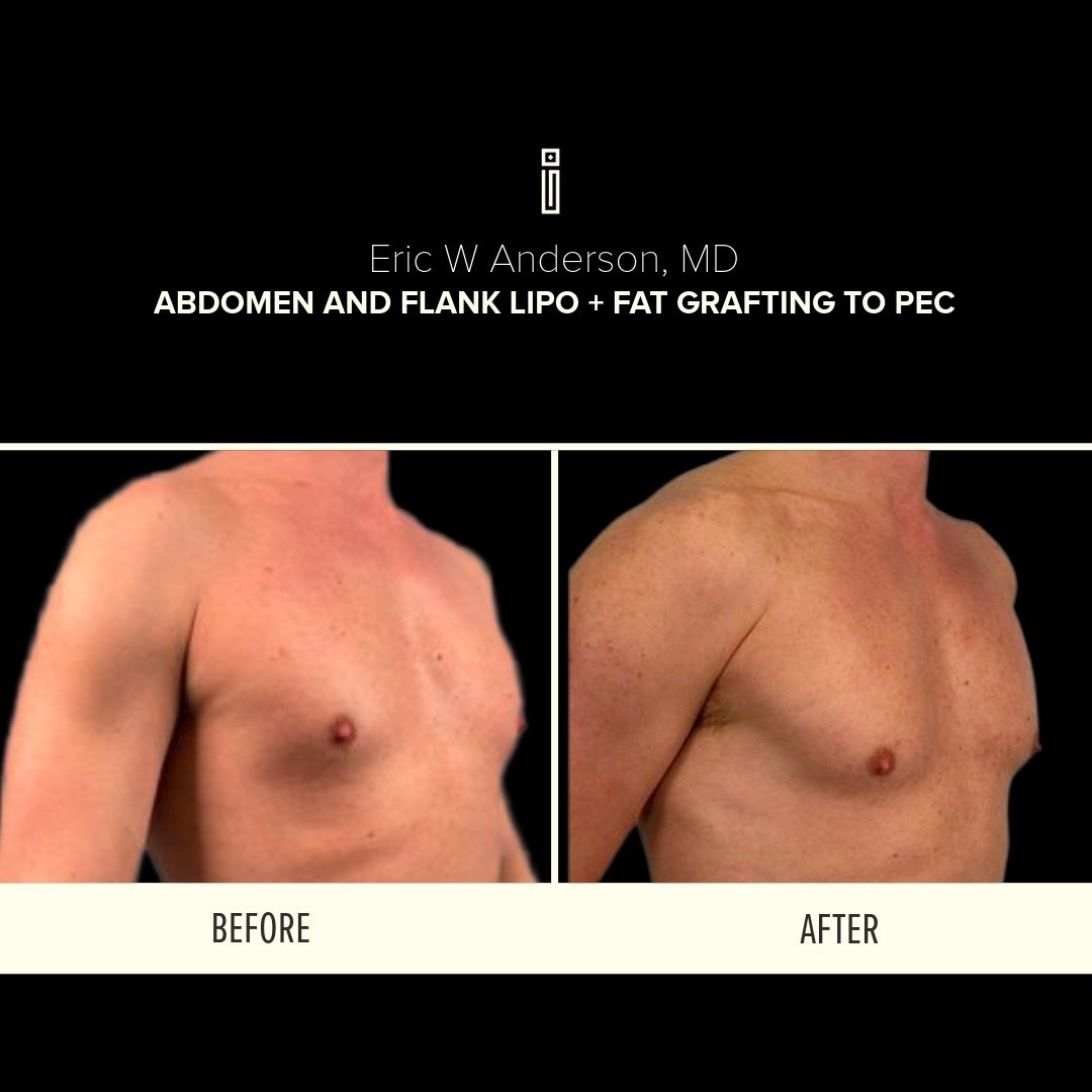 Abdomen + Flank Lipo + fat grafting to pec