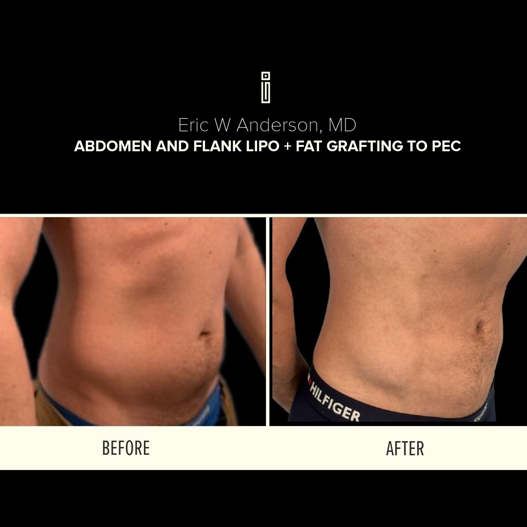 Abdomen + Flank Lipo + fat grafting to pec