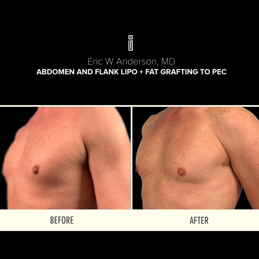 Abdomen + Flank Lipo + fat grafting to pec