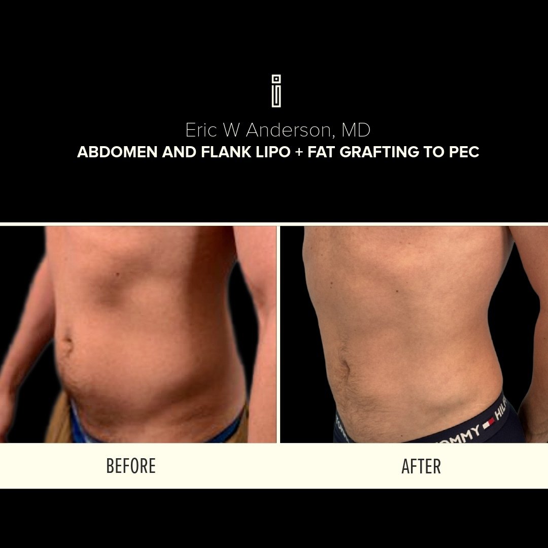 Abdomen + Flank Lipo + fat grafting to pec