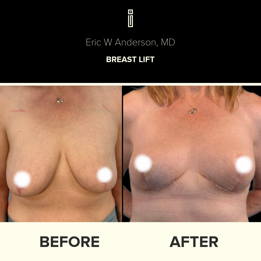 Dr.Anderson_B&A Folder 2-82-Stephanie.S - Breast Lift page