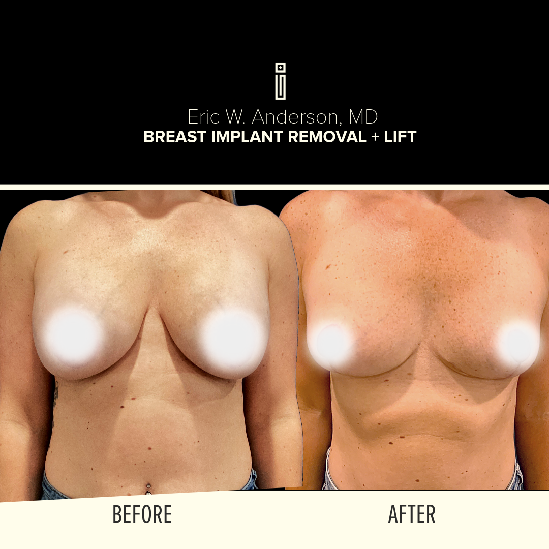 Breast Lift
