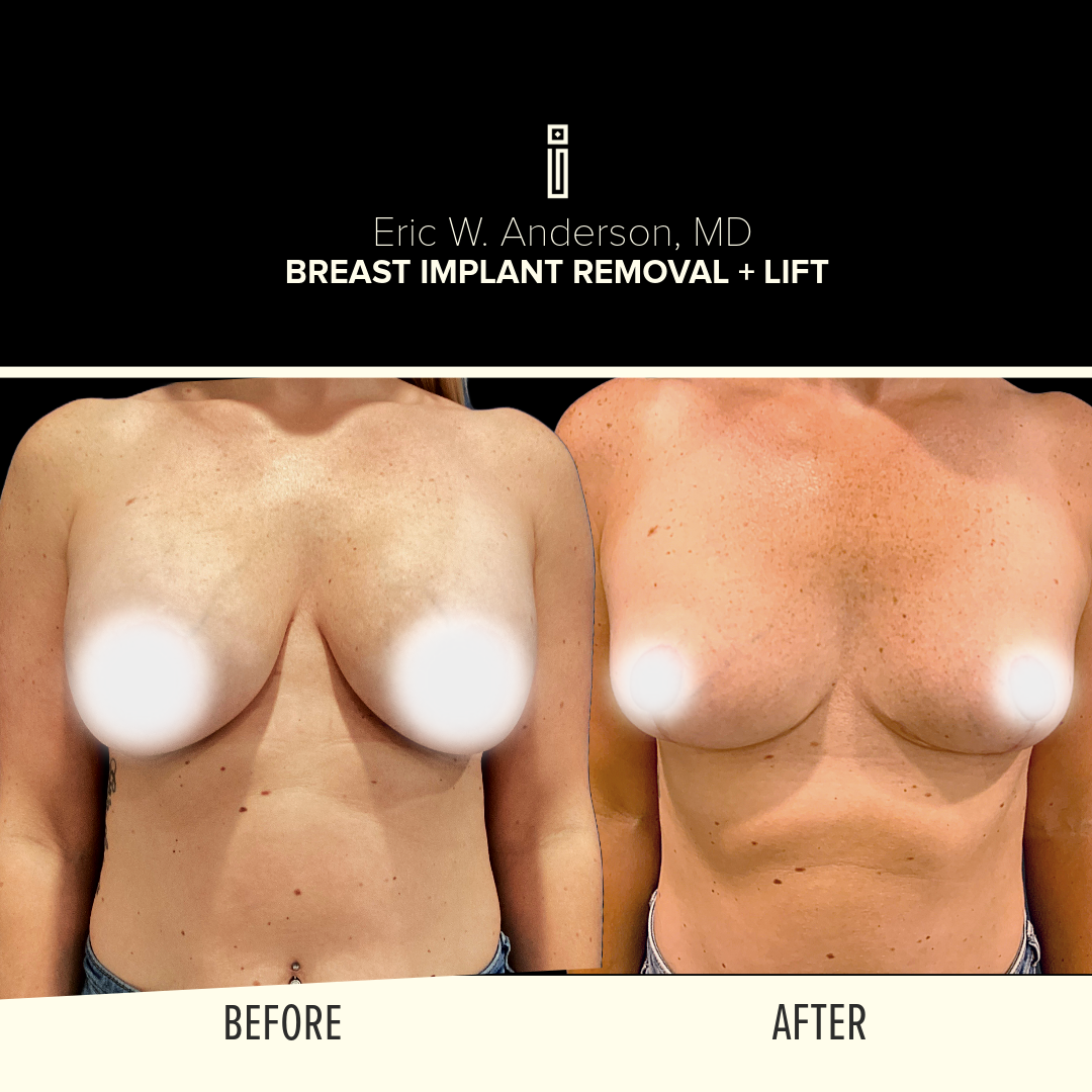 Breast Reduction