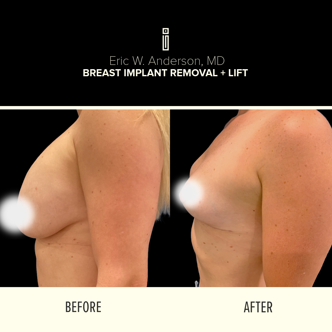 Breast Lift