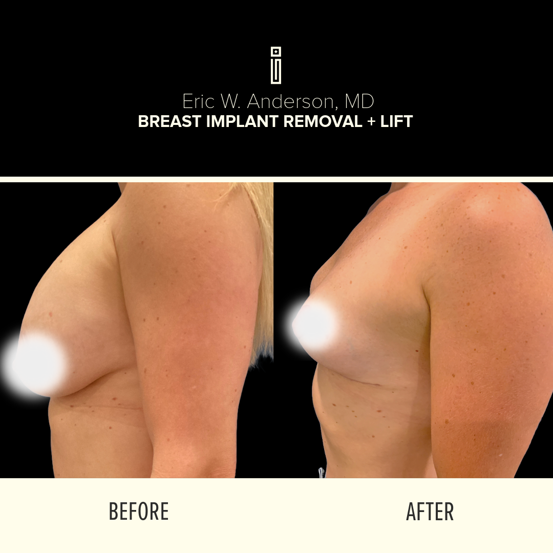 Breast Reduction