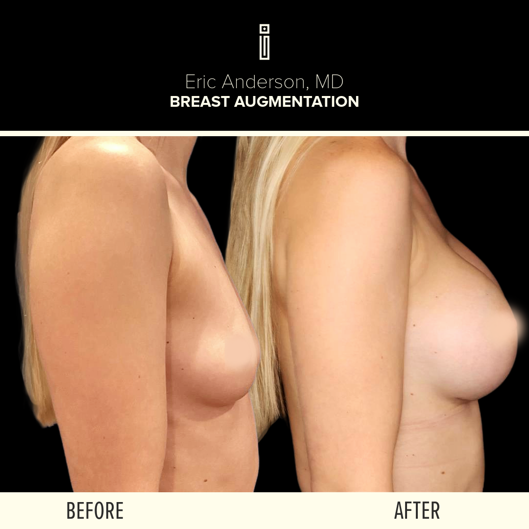 Breast Augmentation