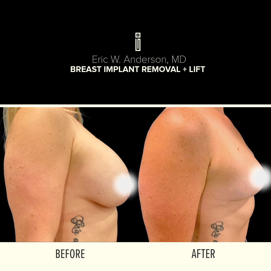Breast Reduction