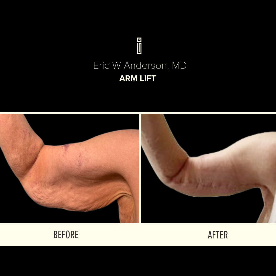 Arm Lift