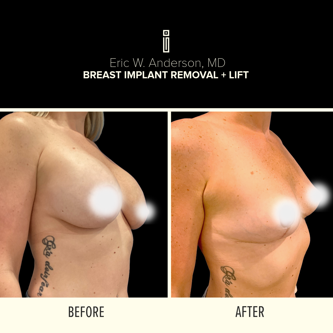 Breast Lift