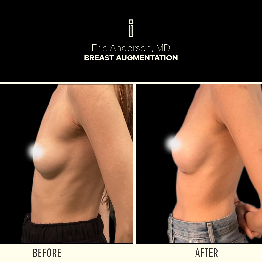 Breast Before and After