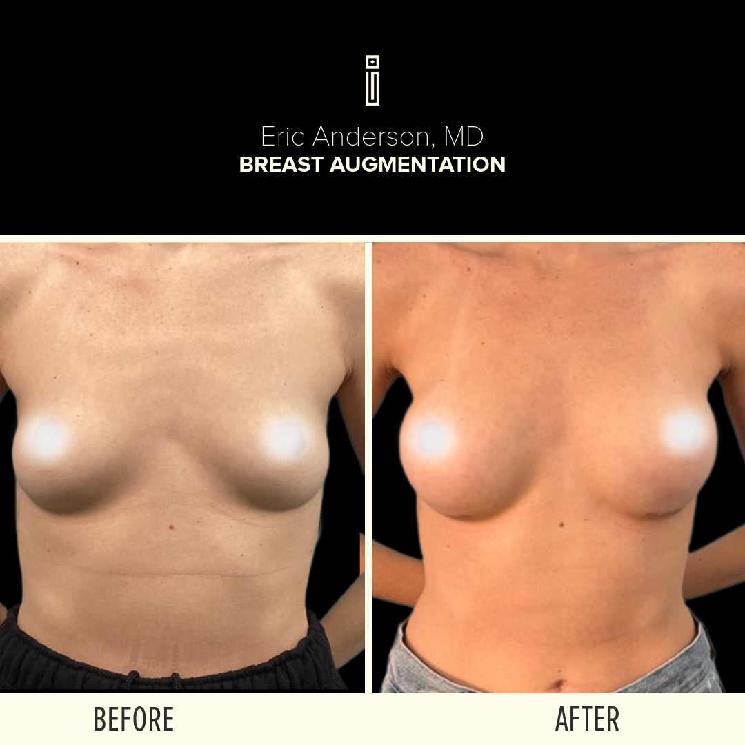 Breast Before and After