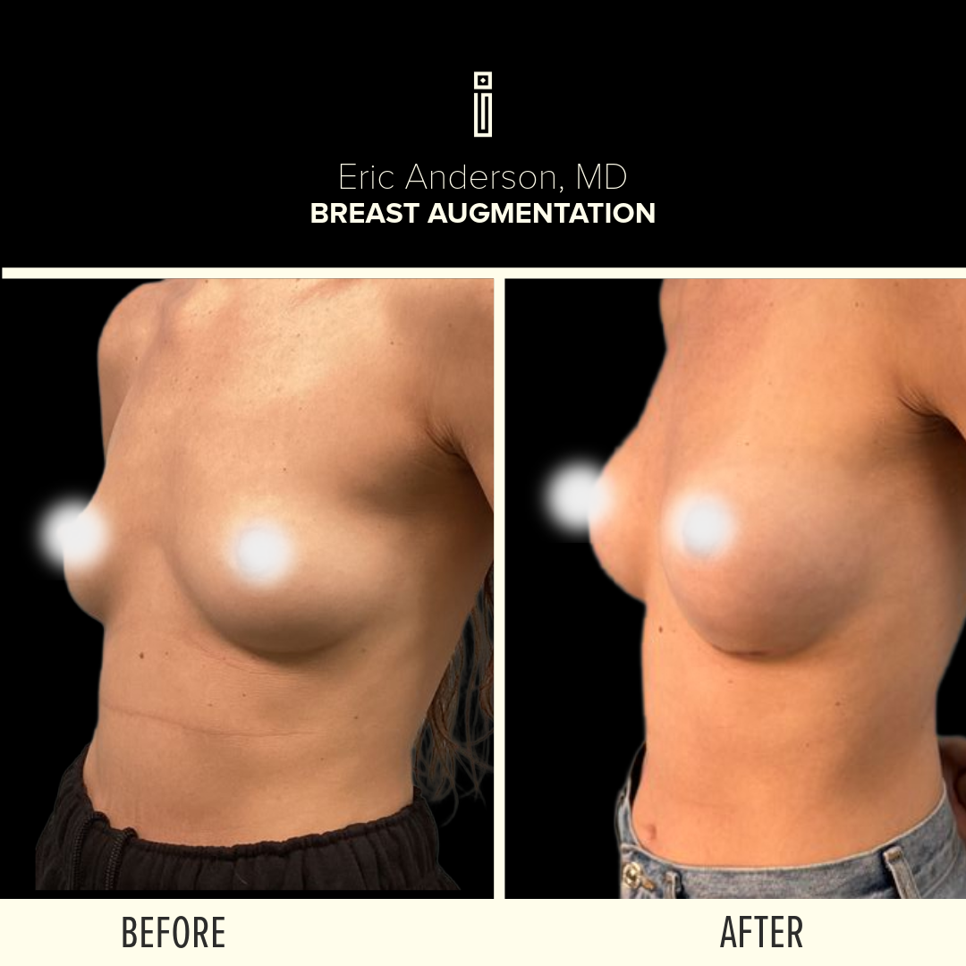 Breast Before and After