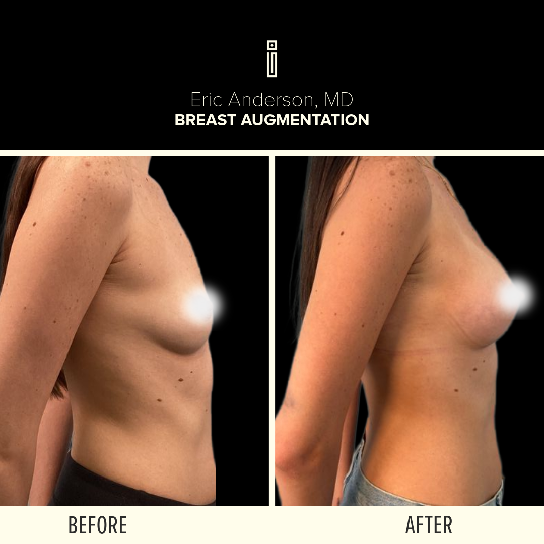 Breast Before and After