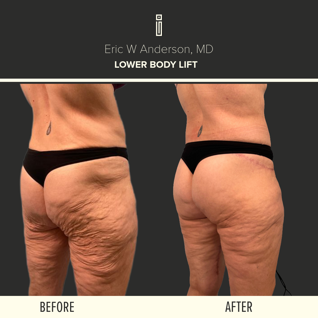 Thigh Lift