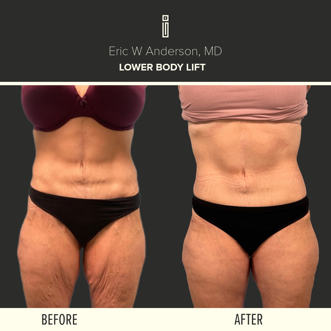 Thigh Lift