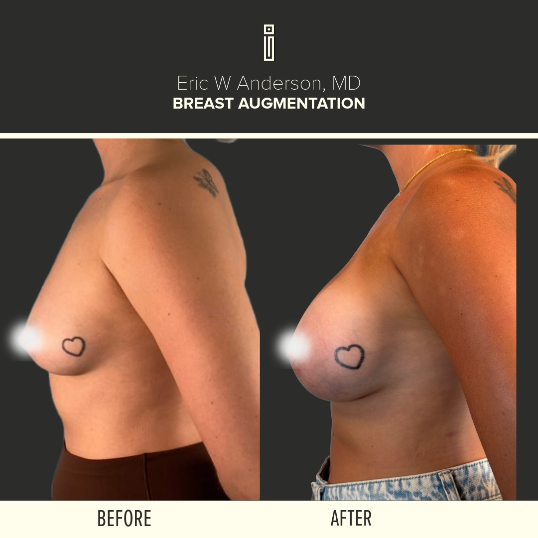 Breast Augmentation