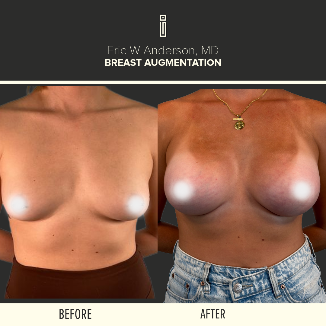 Breast Augmentation