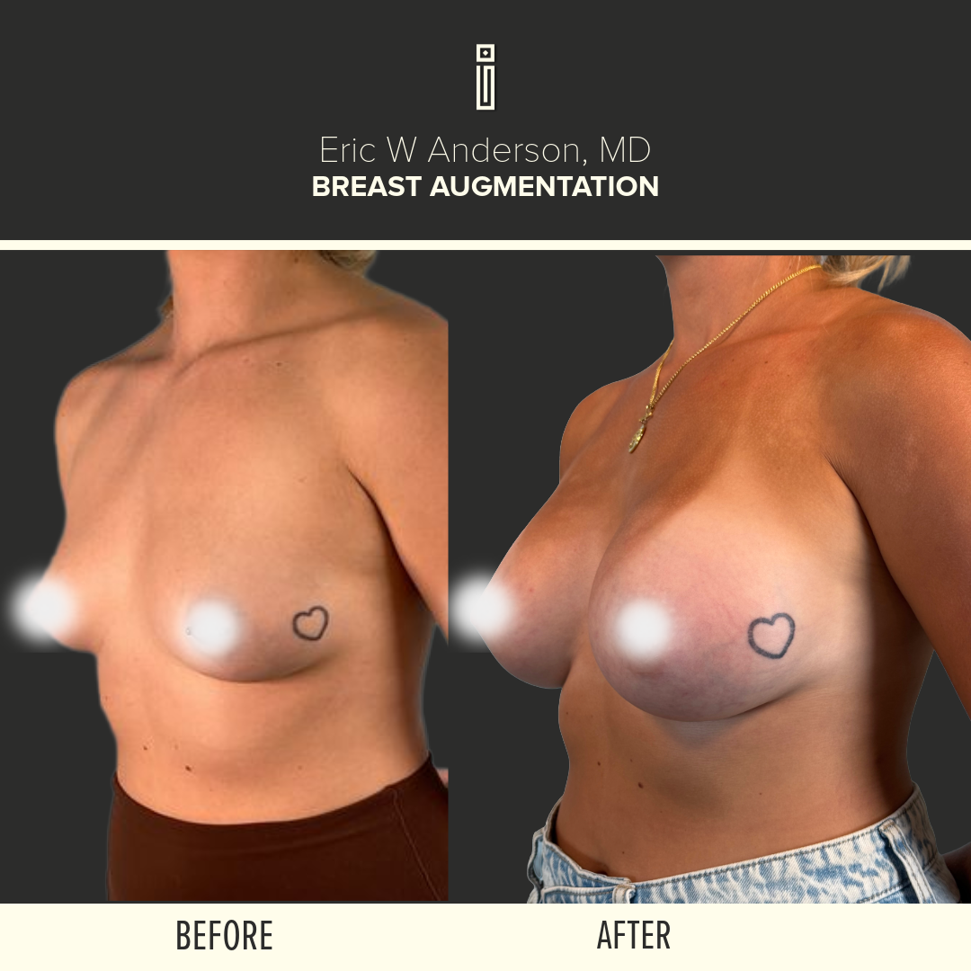 Breast Augmentation